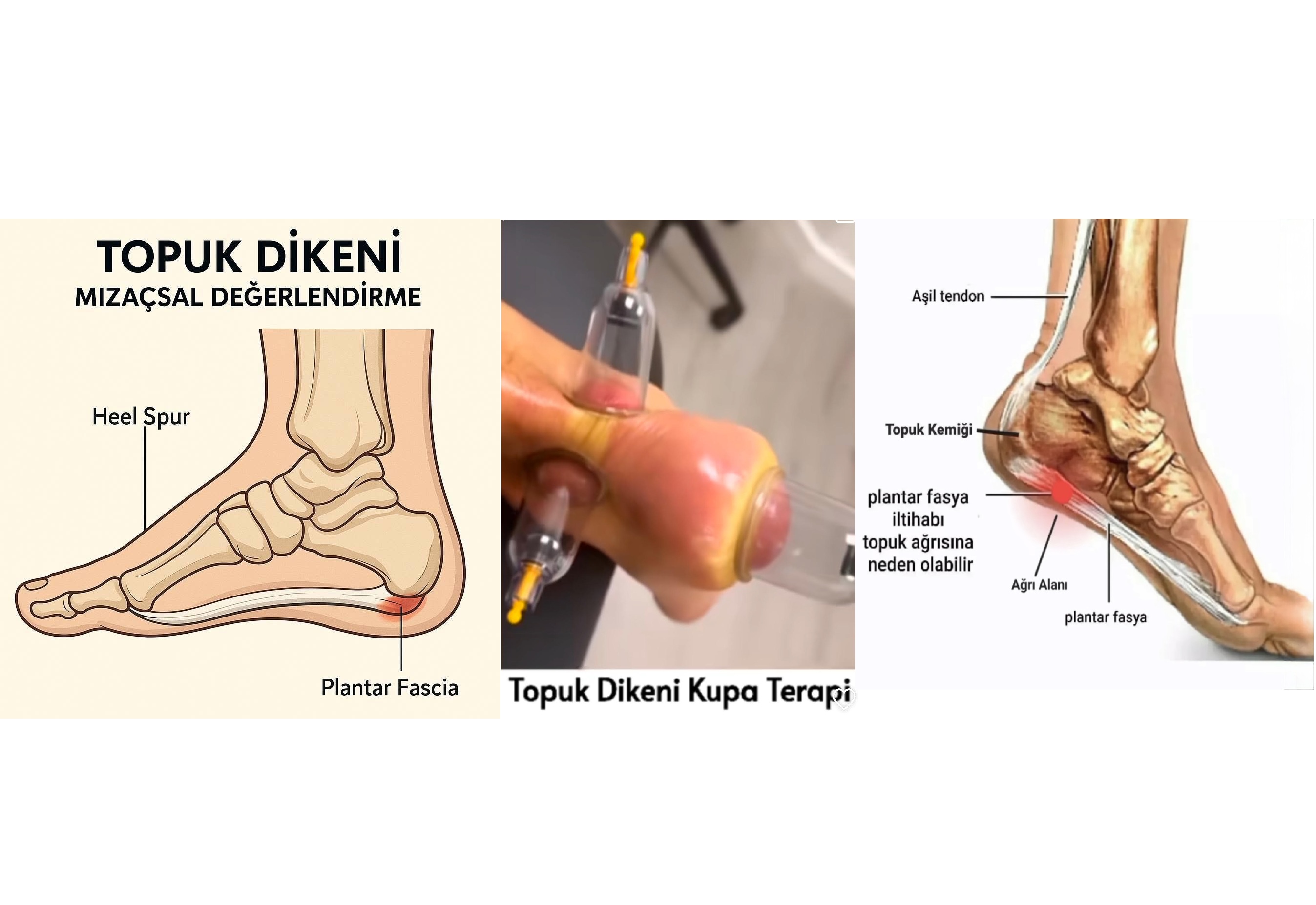 Topuk Dikeni Terapisi